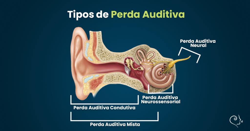 audiograma perda auditiva condutiva